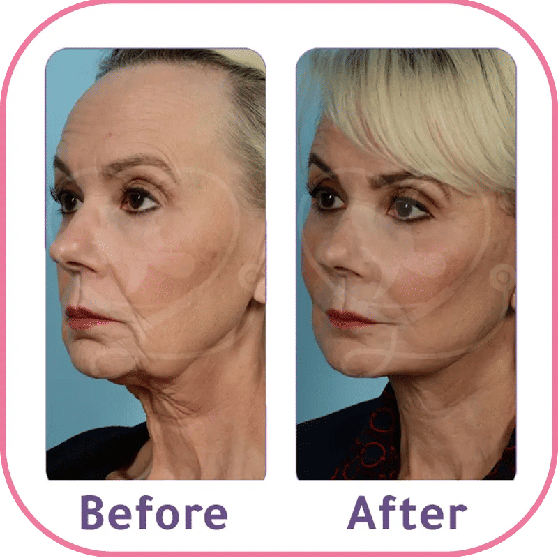 مقارنة قبل وبعد إجراء شد الوجه غير الجراحي في تركيا تظهر اختفاء التجاعيد وشد الجلد