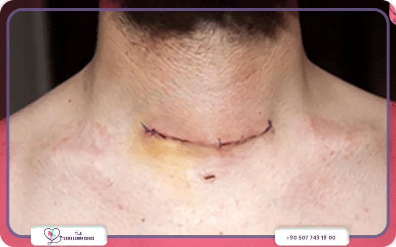 علاج فرط نشاط الغدة الدرقية في تركيا لاكشري كلينك
