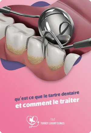 Le tartre dentaire : le guide complet pour l'éliminer et le prévenir