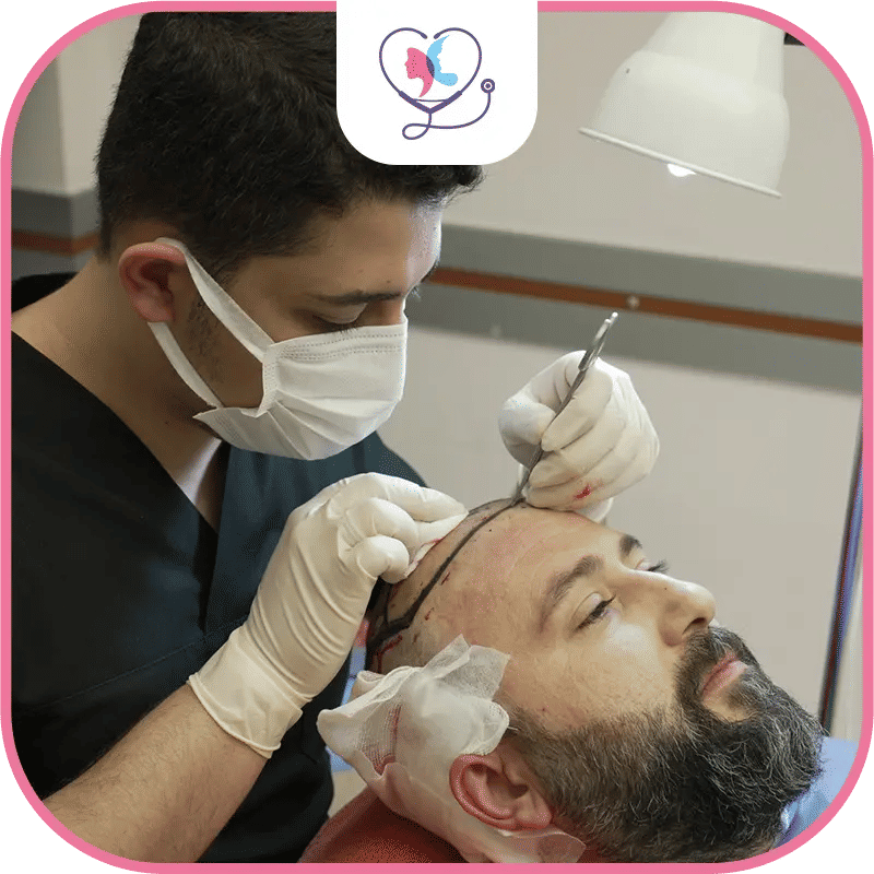 How Long Does Hair Transplant Last?