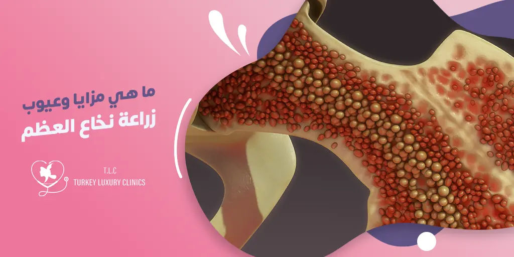 ما هي مزايا وعيوب زراعة نخاع العظم؟