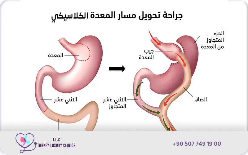 عملية تحويل مسار كلاسيكي