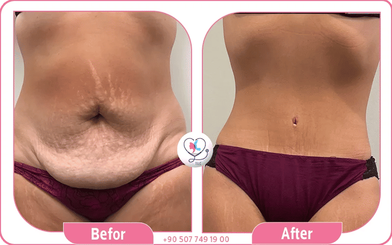 Photos before tummy tuck with Tummy Tuck, loose, stretched abdominal skin and weakened muscles.