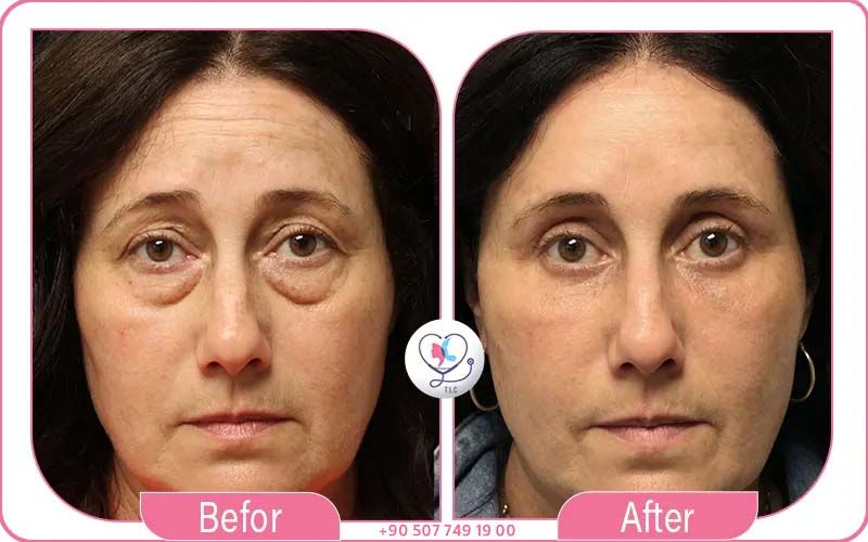 Best Blepharoplasty & Top Surgeons with Turkey Luxury Clinics