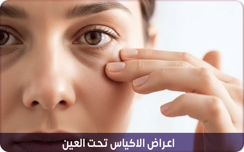 أعراض الاكياس تحت العين