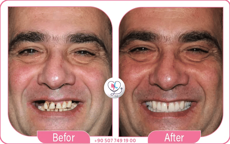 Pourquoi choisir la turquie pour un implant dentaire complet