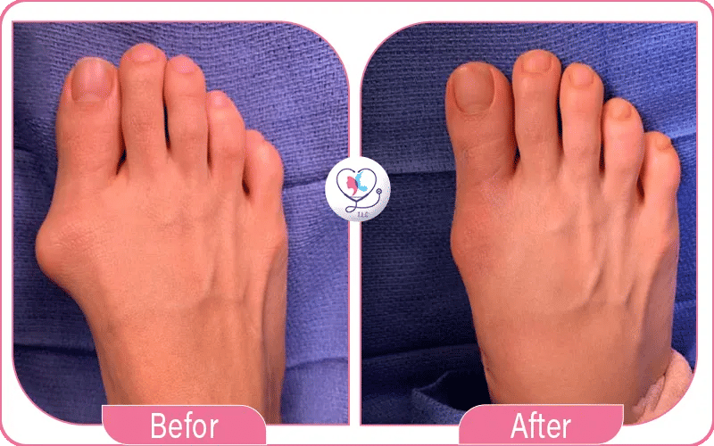 عملية تصحيح أصابع القدم