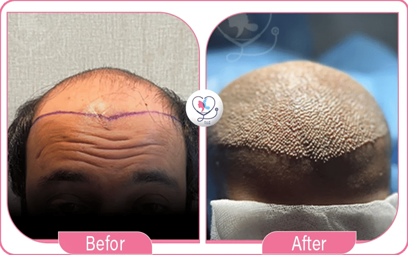 ثانياً: التّقنيات المستخدمة في زراعة الشعر-2