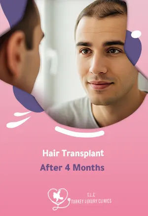 Haartransplantation nach 4 Monaten: Was erwartet Sie