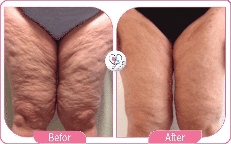 مميزات عملية شد الأفخاذ بالليزر