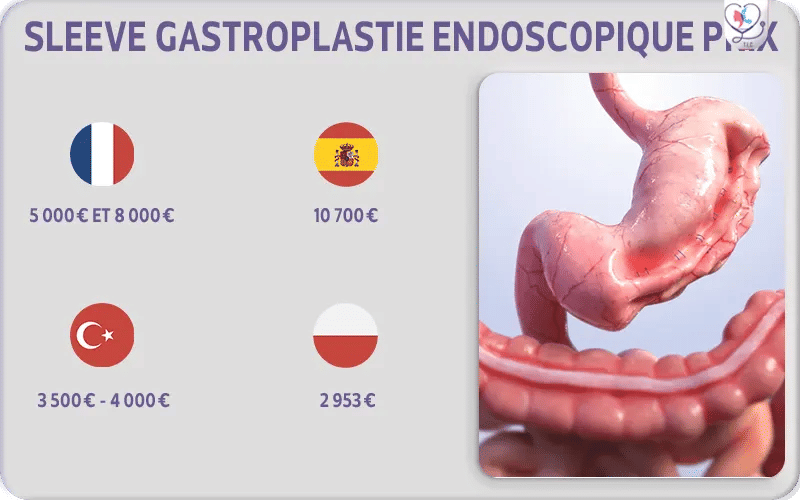 sleeve gastroplastie endoscopique prix