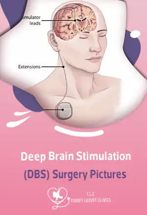 Deep Brain Stimulation Surgery Pictures Explained