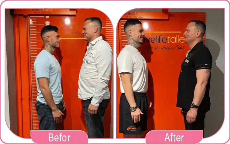 Surgery to Get Taller Before and After