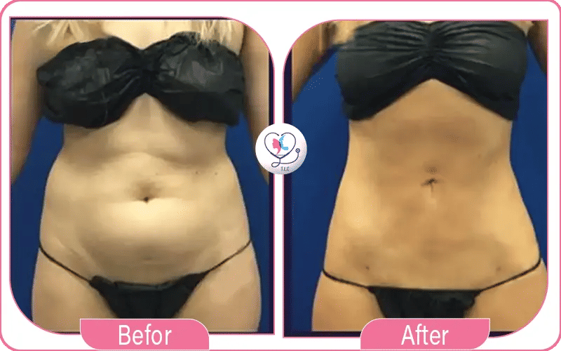 المرشحون لشفط دهون البطن