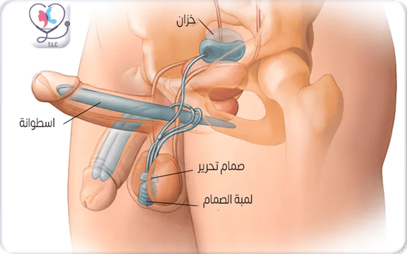 كيف تعمل الدعامة الهيدروليكية؟