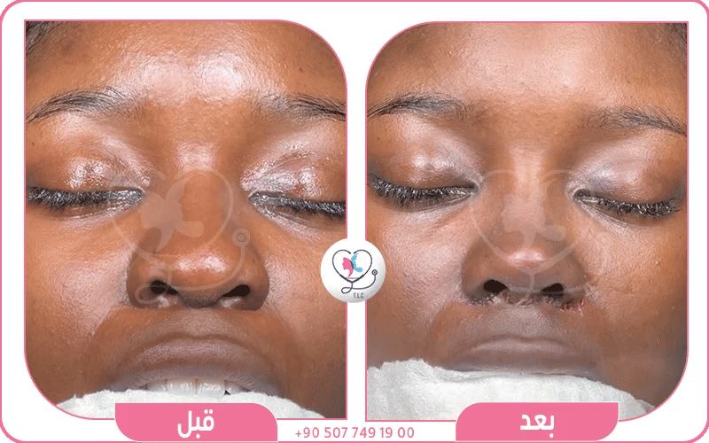 جدول أسعار عملية تجميل الأنف في السعودية