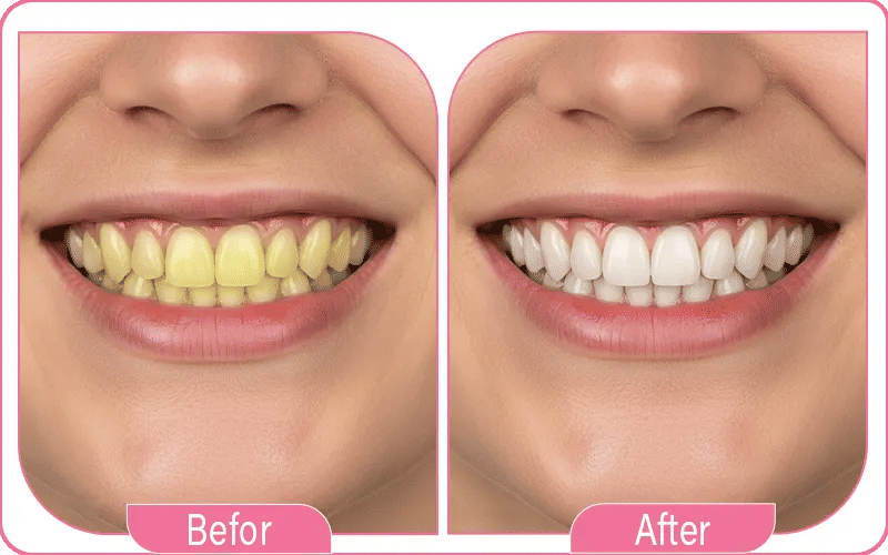 Smile Makeover Before and After
