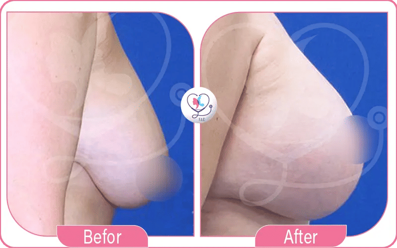 2. La réduction mammaire