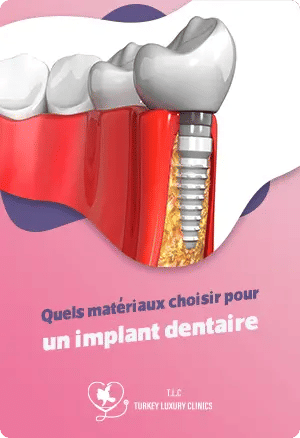 Quels matériaux choisir pour un implant dentaire
