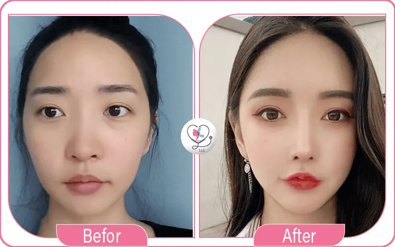 نتائج عملية تجميل الأنف الأفطس