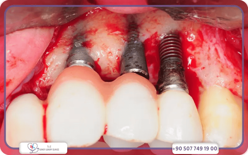 Risques et complications possibles de l’implant dentaire