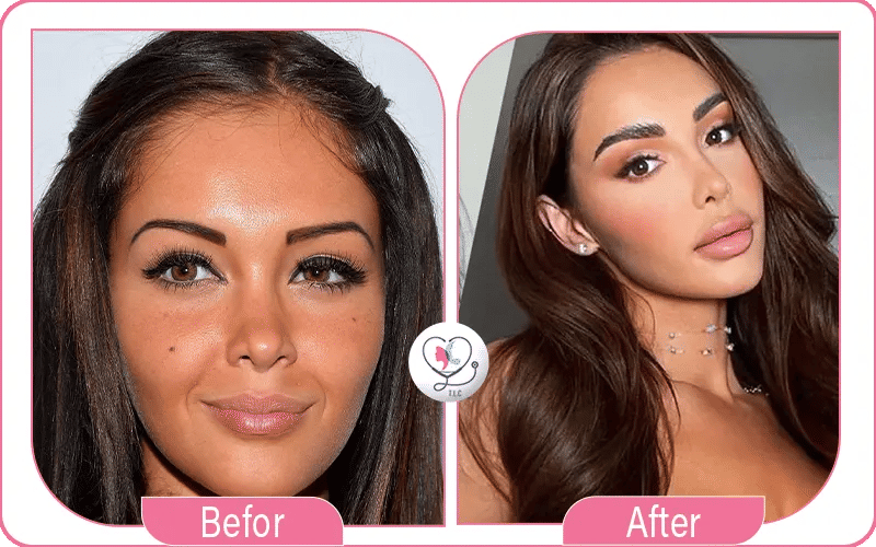 La rhinoplastie de Nabilla
