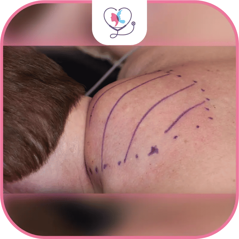 bosse de bison - liposuccion bosse de bison prix