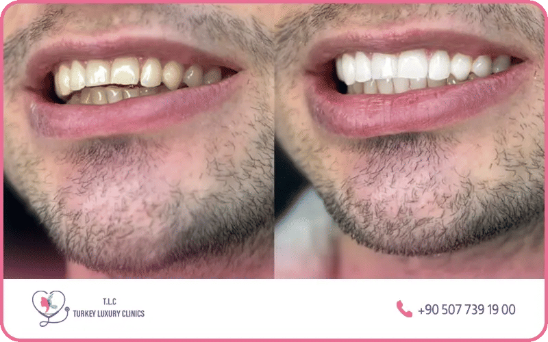 Teeth whitening Turkey before and after photos – laser, Beyond, and Zoom whitening dramatic smile transformation results