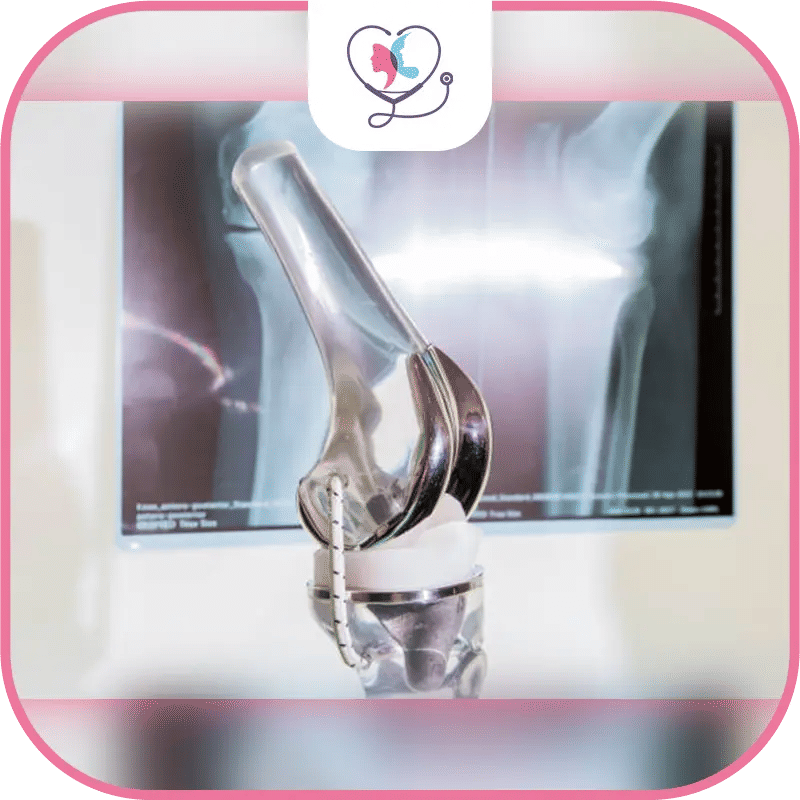 De quels matériaux est faite la prothèse du genou ?