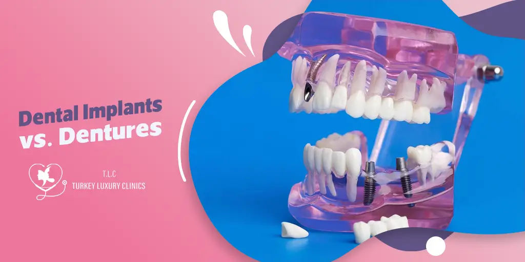 Dental Implants vs. Dentures: Weighing the Pros and Cons to Make the Right Choice