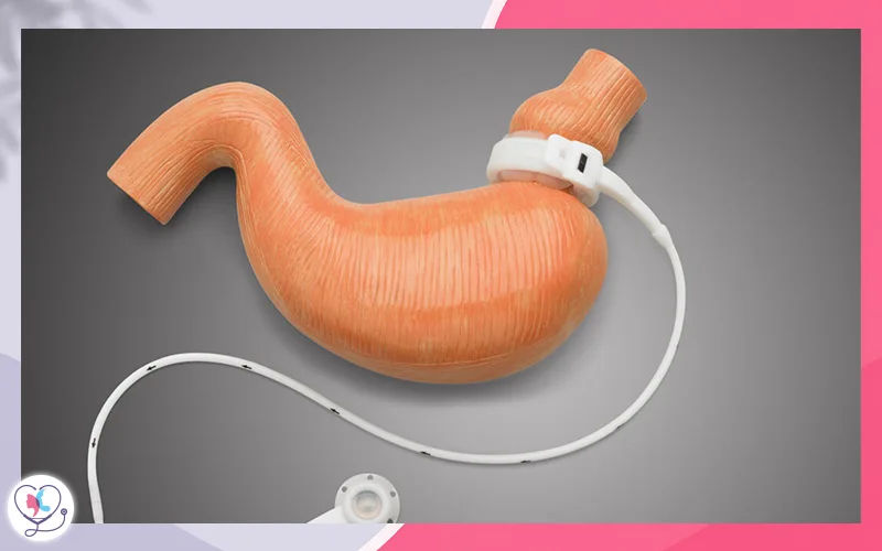 Gastric banding