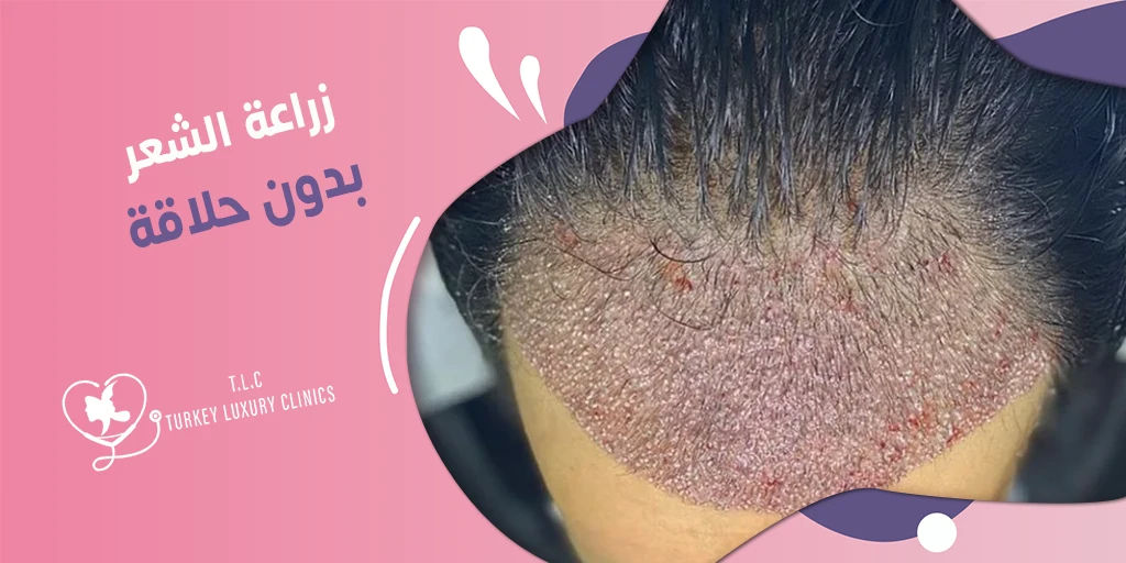 زراعة الشعر بدون حلاقة: هل يُمكن ذلك؟ اقرأ التفاصيل