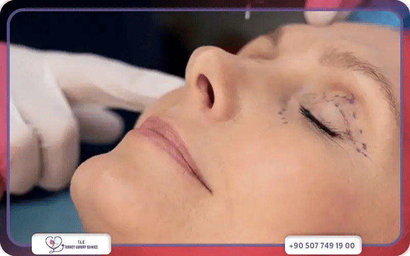 لماذا تختار تركيا لإجراء عملية شد الجفون؟