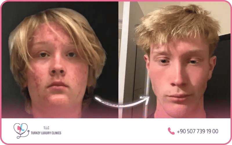comment maigrir du visage homme
