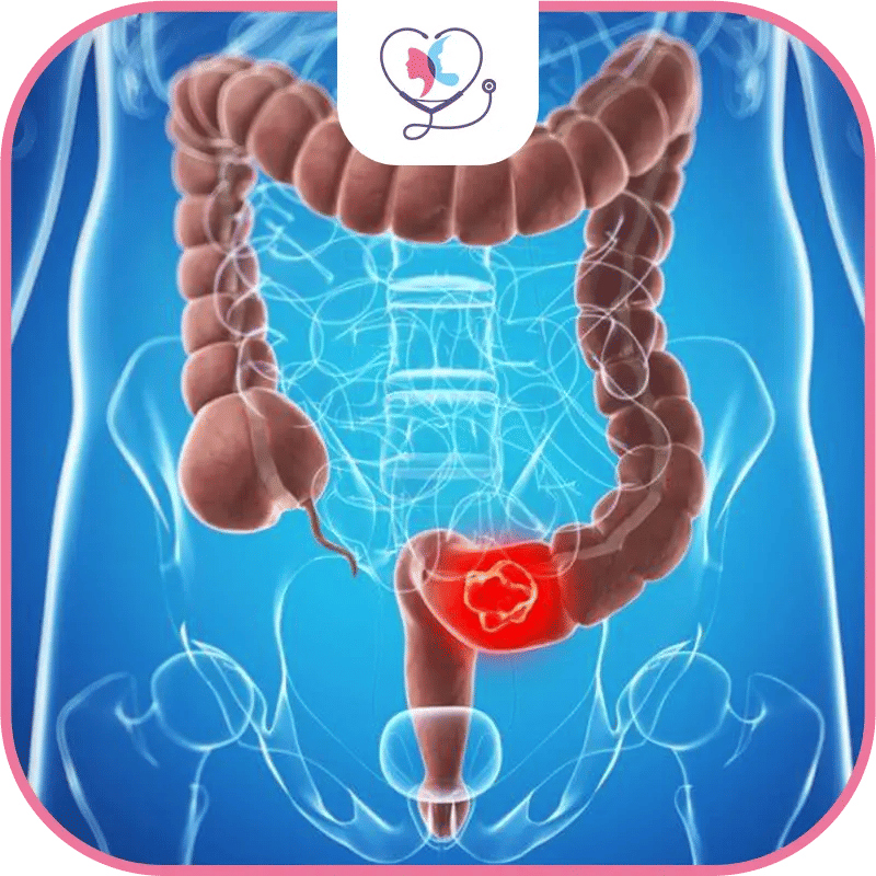 جراحة سرطان القولون