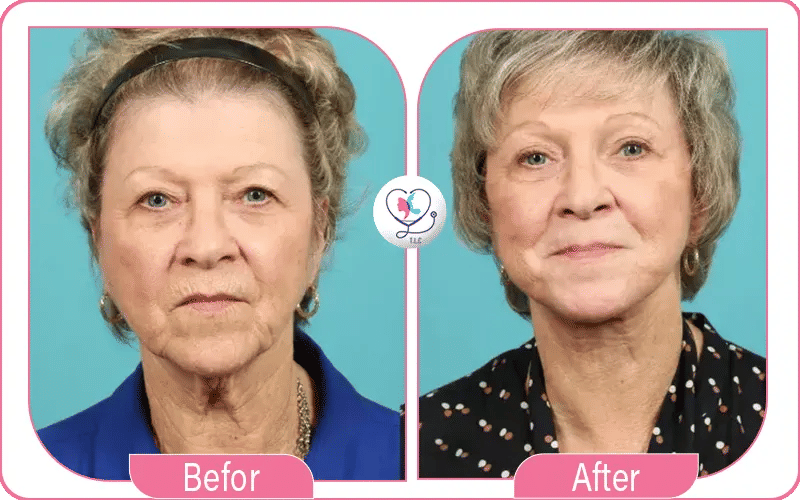 After non Surgical Neck Lift