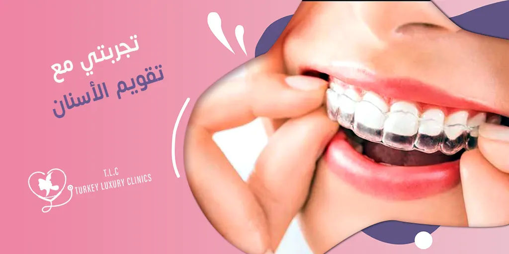 تجربتي مع تقويم الأسنان: نتائج حقيقية مع صور قبل وبعد