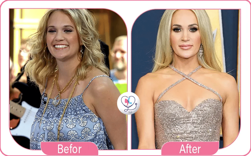 Carrie Underwood Plastic Surgery Before and After
