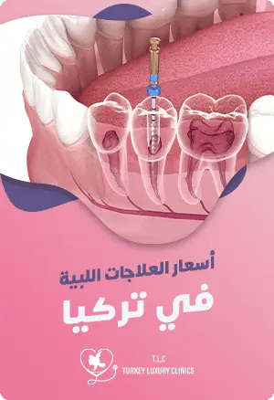 أسعار العلاجات اللبية في تركيا featured image