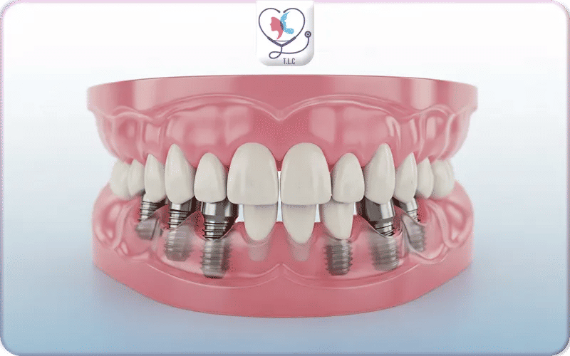 What Are All on 6 Dental Implants?