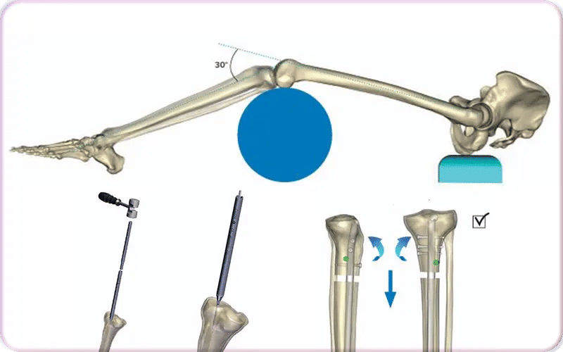 How Fitbone Orthofix Surgery Works