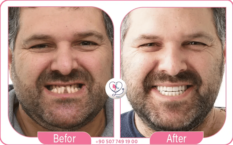 facette dentaire et implants dentaire avant après