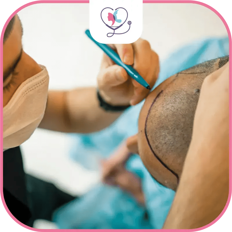 Hair Transplant Week by Week