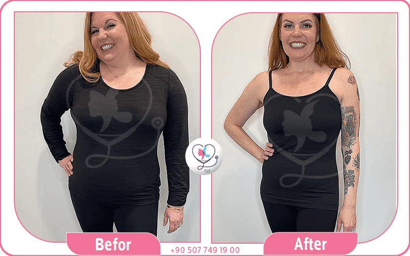 تجاربكم مع ابر اوزمبك في تركيا لاكشري كلينك 