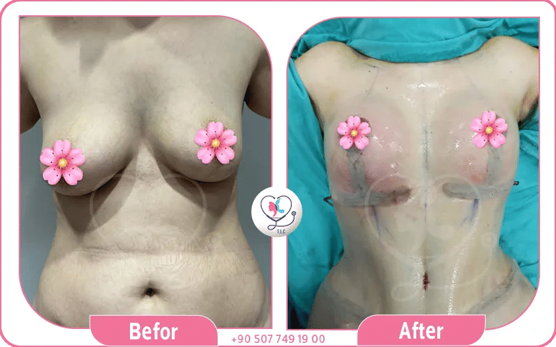 عمليات تجميل الثدي في سوريا