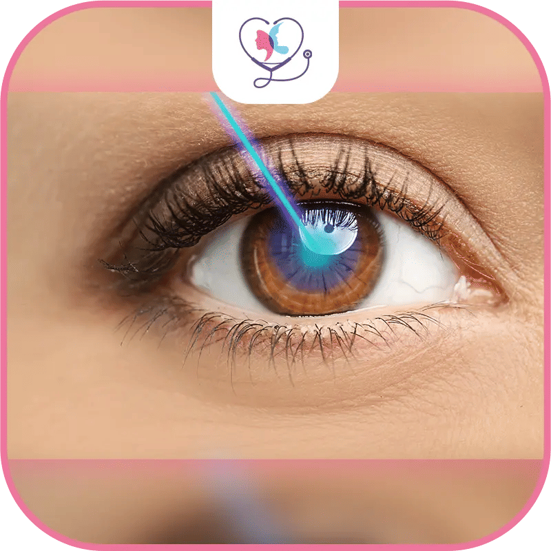 خطوات عملية الليزك