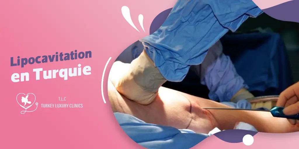 Lipocavitation en Turquie : amincissement sans chirurgie