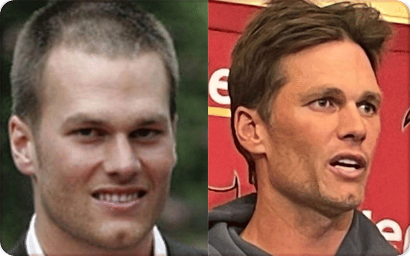What Plastic Surgery Has Tom Brady Had?