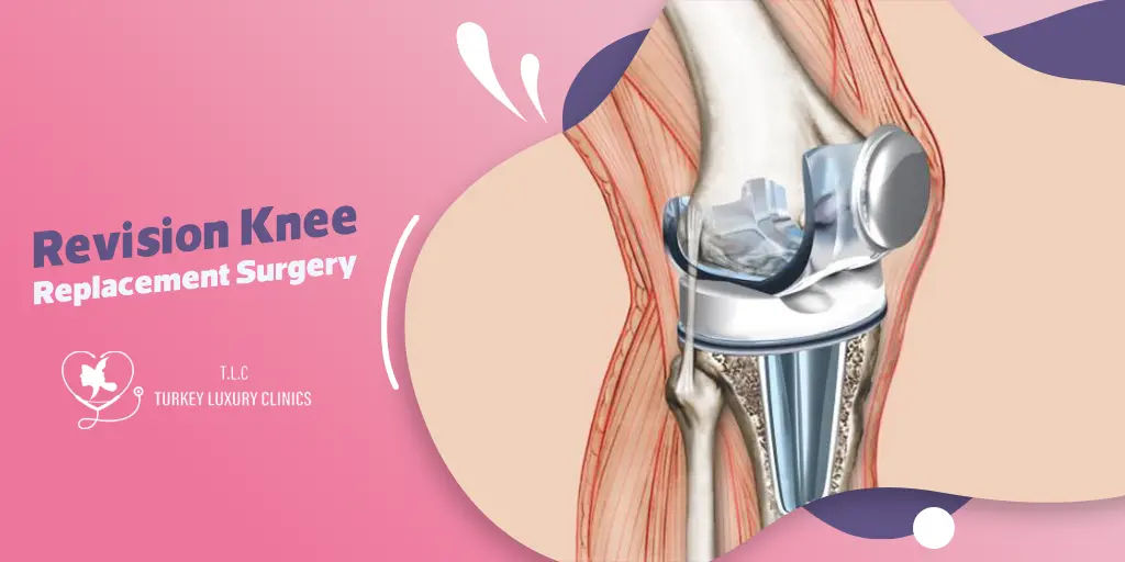 Revision Knee Replacement Surgery