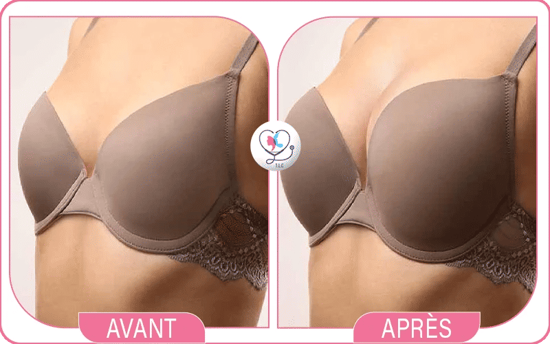 Augmentation mammaire avant/après